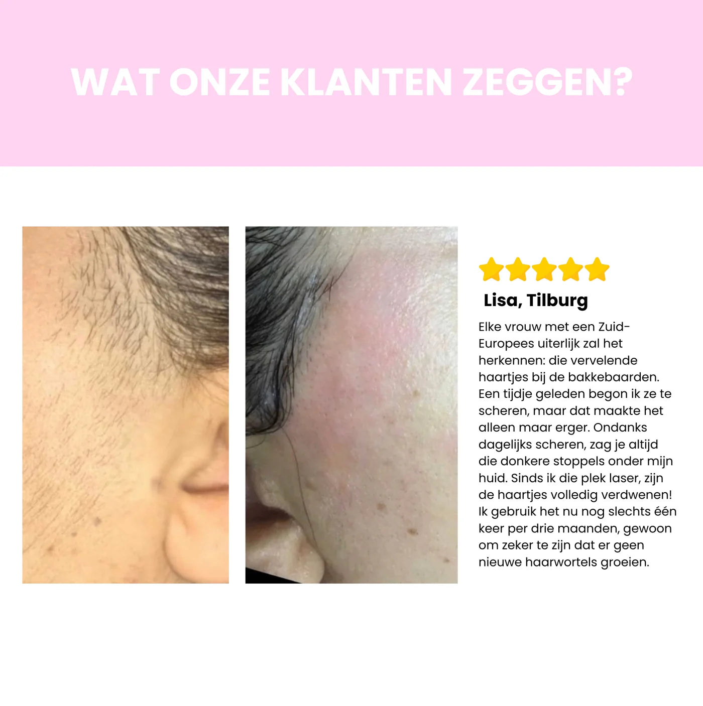 Sidea IPL Haarverwijderaar – Professionele laserontharing voor thuisgebruik